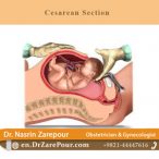 secarean section