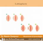 labiaplasty